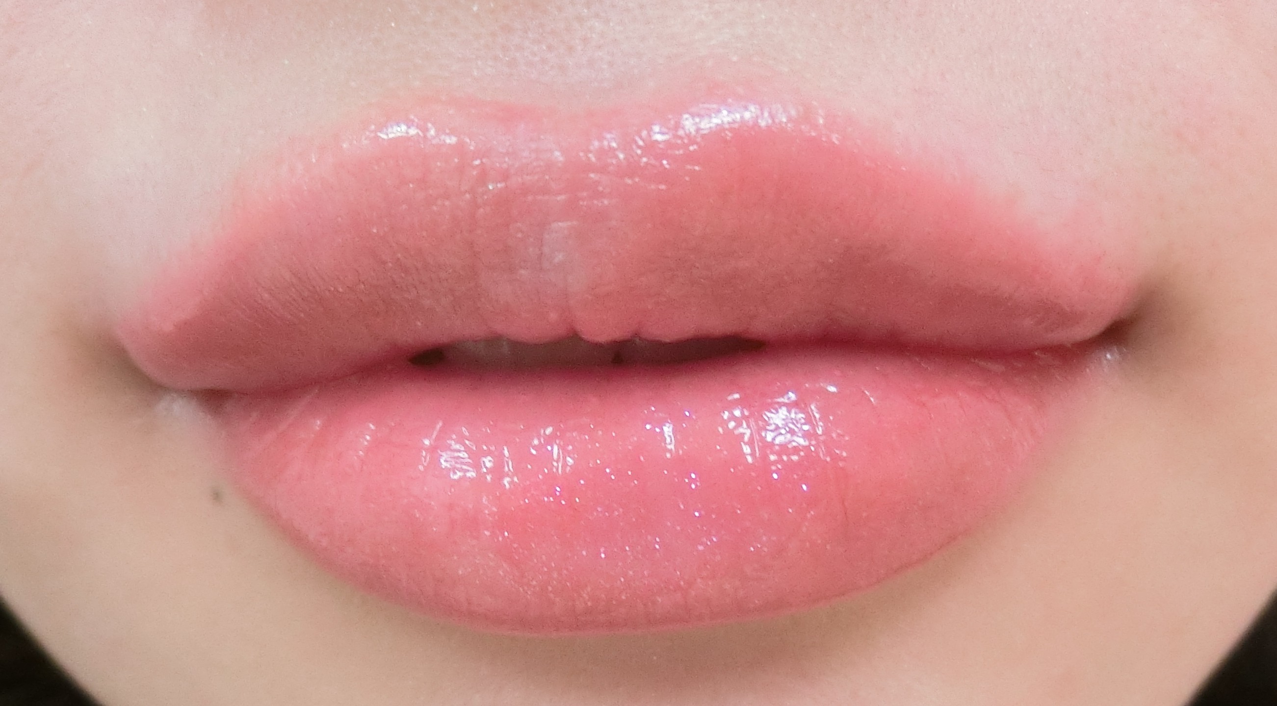 ヒアルロン酸プチ整形 プルプル唇 専用ヒアルロン酸スタイレージspecial Lips 表参道美容外科クリニック