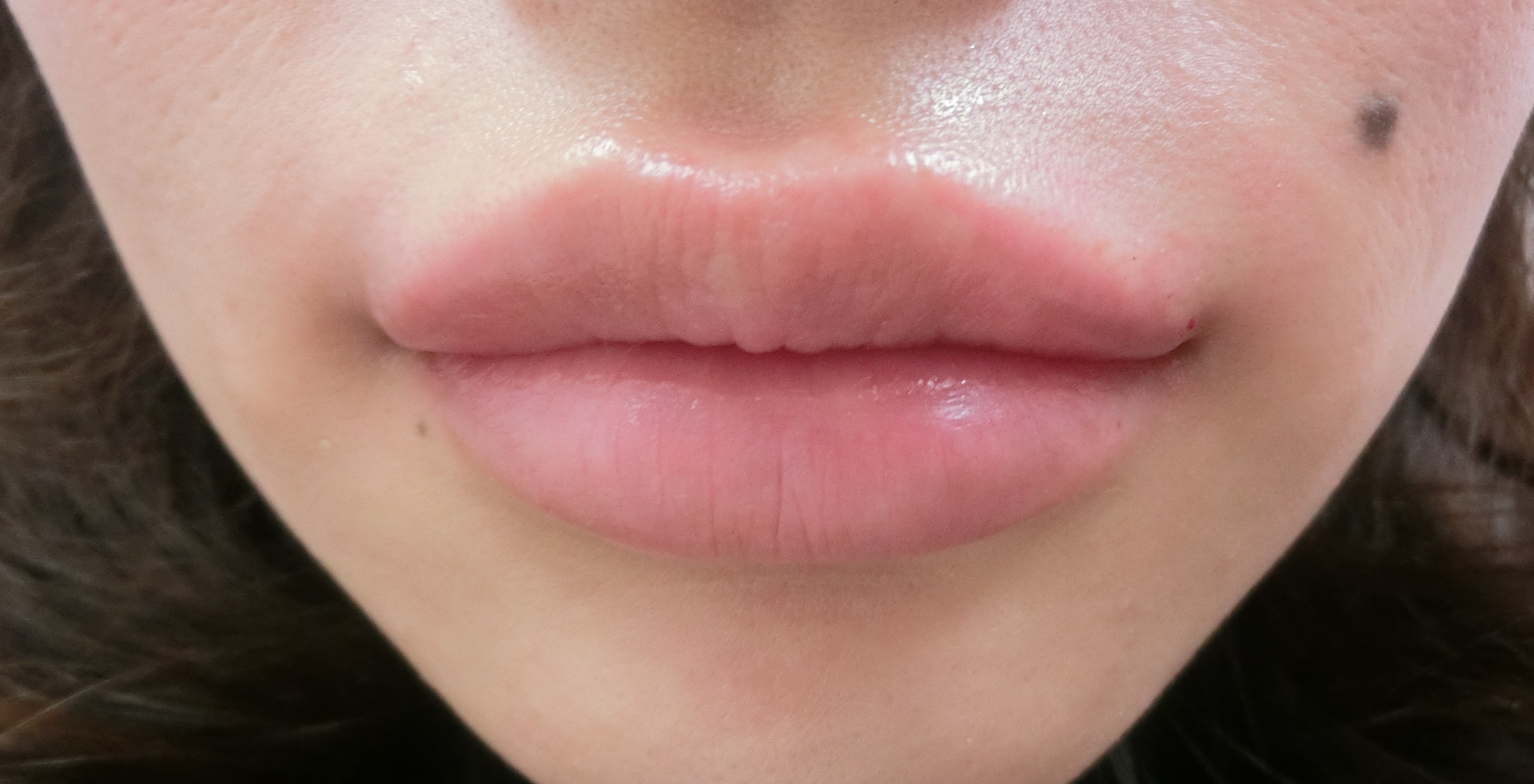 1、口裂（ oralfissure）上下唇之间的横_圈子-新氧美容整形