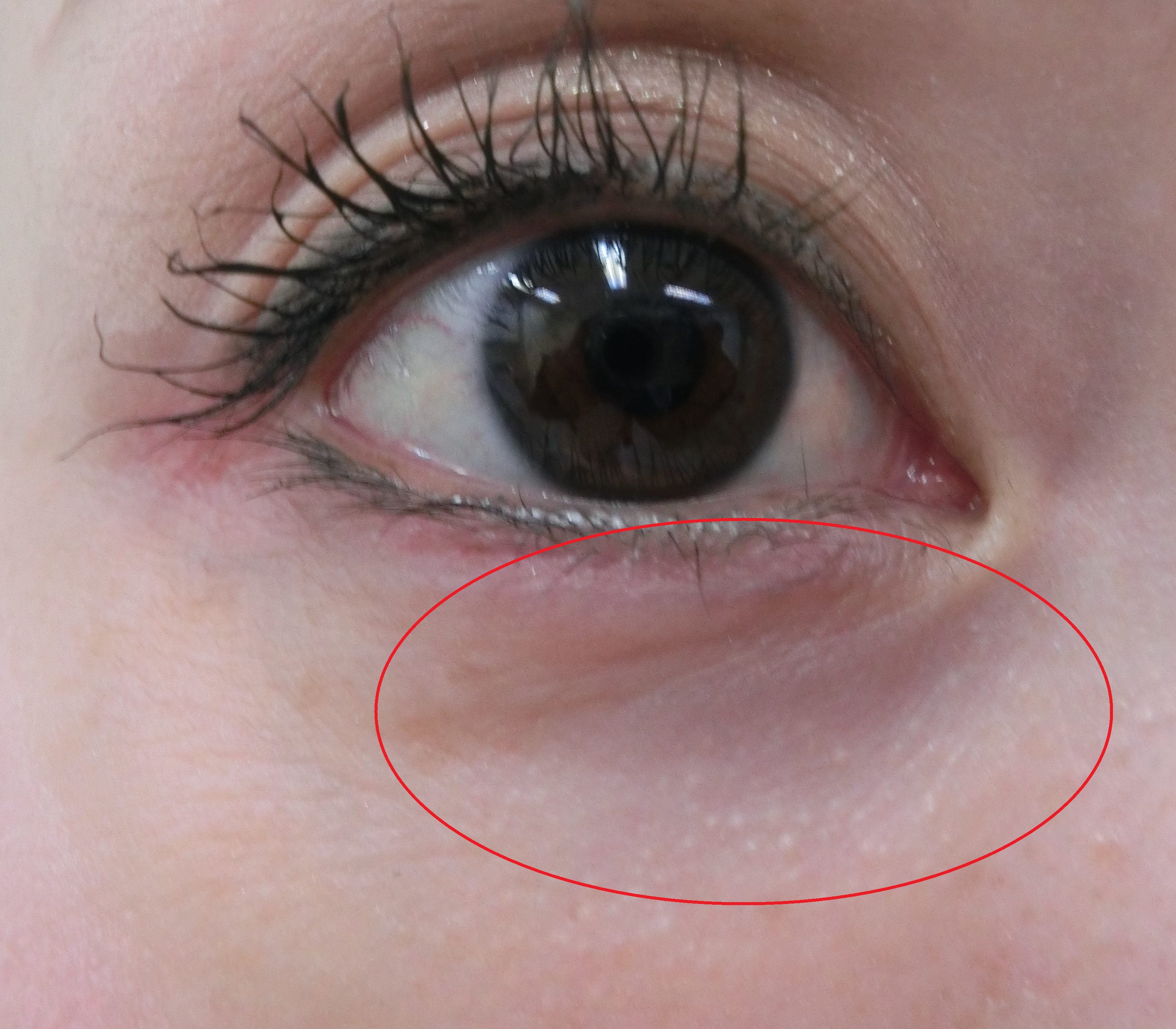 目の下のくぼみ くまに ヒアルロン酸注入で疲れ顔解消 表参道美容外科クリニック