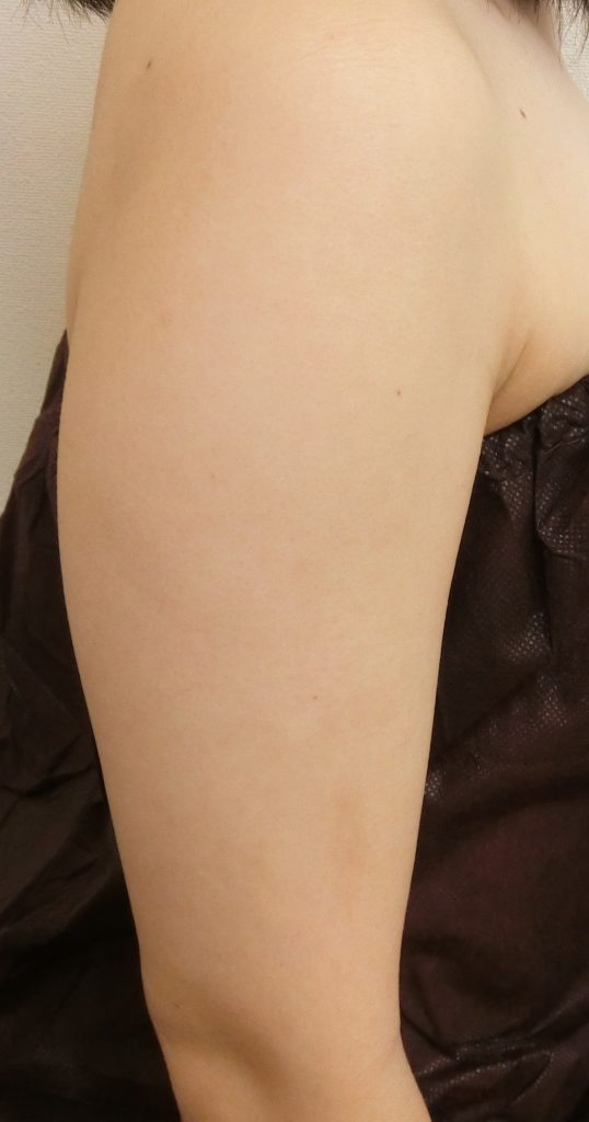 エクセル 腹部 二の腕の部分痩せモニター 表参道美容外科クリニック