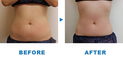 インモードFX　腹部 症例 ビフォア・アフター