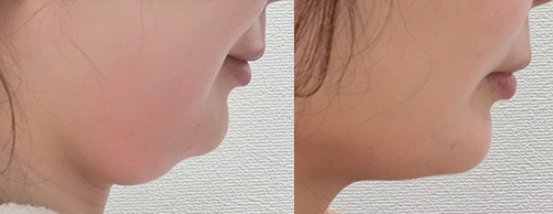 インモードFXフェイス症例 ほほ・あご下 ビフォア・アフター