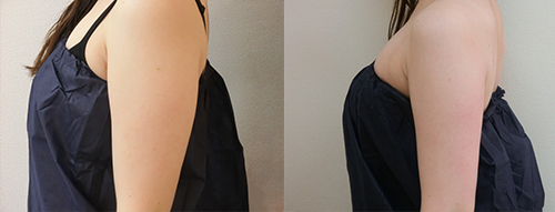 インモードFXボディ症例 二の腕 ビフォア・アフター