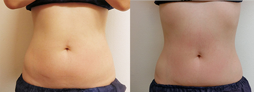 インモードFXボディ症例 腹部 ビフォア・アフター